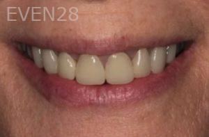 Lincoln-Parker-Dental-Crowns-before-4