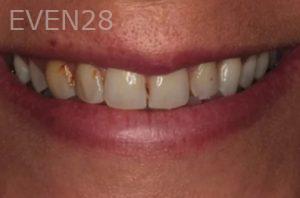Lincoln-Parker-Dental-Crowns-before-5