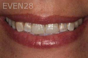 Lincoln-Parker-Dental-Crowns-before-6