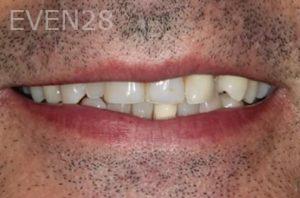 Lincoln-Parker-Dental-Crowns-before-7