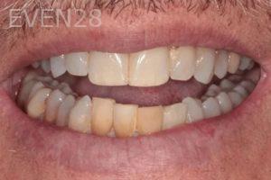 Lincoln-Parker-Dental-Crowns-before-9