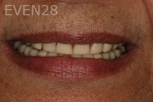 Lincoln-Parker-Dentures-before-1