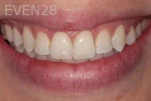 Lincoln-Parker-Invisalign-clear-aligners-after-1
