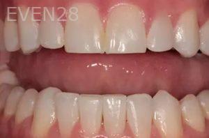 Lincoln-Parker-Invisalign-clear-aligners-after-2