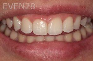 Lincoln-Parker-Invisalign-clear-braces-after-4