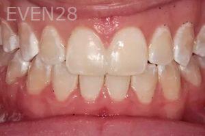 Lincoln-Parker-Invisalign-clear-aligners-after-5