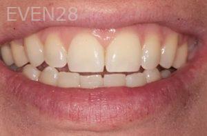 Lincoln-Parker-Invisalign-clear-aligners-after-6