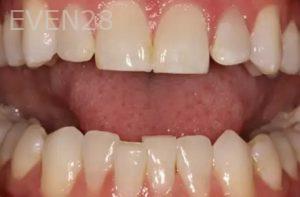 Lincoln-Parker-Invisalign-clear-aligners-before-2