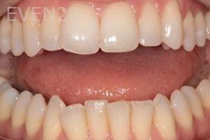 Lincoln-Parker-Invisalign-clear-aligners-before-3