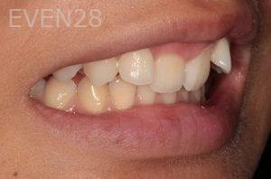 Lincoln-Parker-Invisalign-clear-aligners-before-4