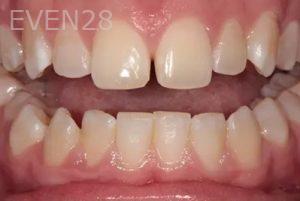 Lincoln-Parker-Invisalign-clear-aligners-before-5