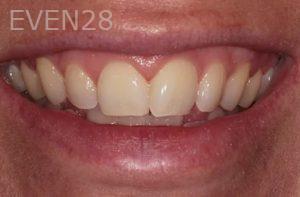 Lincoln-Parker-Invisalign-clear-aligners-before-6