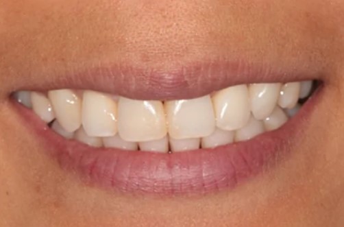 Lincoln-Parker-Teeth-Whitening-after-1