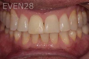 Lincoln-Parker-Teeth-Whitening-after-2