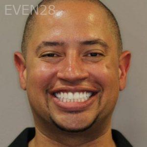 Mark-Nguyen-Invisalign-clear-aligners-after-1