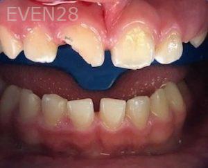 Maryam-Ekhtiar-Dental-Bonding-before-1