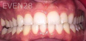 Maryam-Ekhtiar-Orthodontic-Braces-after-2