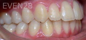 Maryam-Ekhtiar-Orthodontic-Braces-after-3