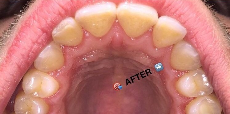 Maryam-Ekhtiar-Orthodontic-Braces-after-6