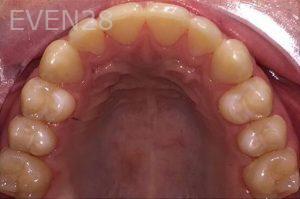 Maryam-Ekhtiar-Orthodontic-Braces-after-7