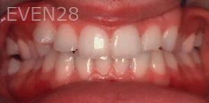 Maryam-Ekhtiar-Orthodontic-Braces-before-2