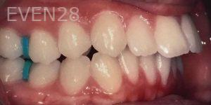 Maryam-Ekhtiar-Orthodontic-Braces-before-3