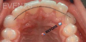 Maryam-Ekhtiar-Orthodontic-Braces-before-6