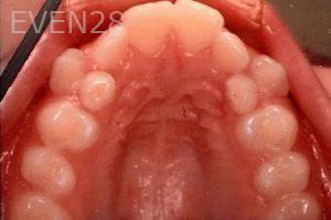Maryam-Ekhtiar-Orthodontic-Braces-before-7