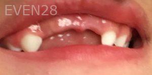 Maryam-Ekhtiar-Pediatric-Dental-Care-before-1