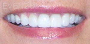 Maryam-Ghasemyeh-Dental-Crown-After-1