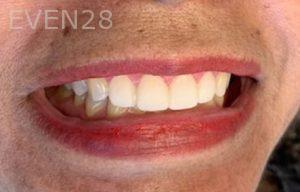 Maryam-Ghasemyeh-Dental-Crown-After-2