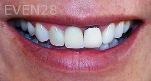 Maryam-Ghasemyeh-Dental-Crown-Before-1