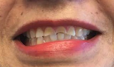 Maryam-Ghasemyeh-Dental-Crown-Before-2