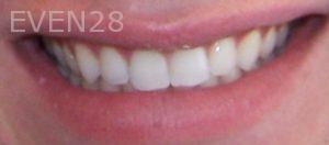 Maryam-Ghasemyeh-Invisalign-Clear-Aligners-After-1