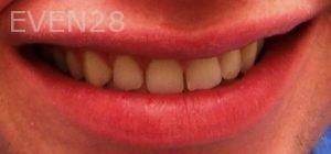 Maryam-Ghasemyeh-Invisalign-Clear-Aligners-Before-1