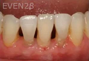 Michael-Hyeonju-Choi-Dental-Implant-After-1