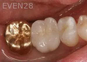 Michael-Hyeonju-Choi-Dental-Implant-After-2