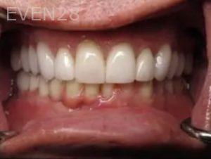 Michael-Hyeonju-Choi-Dental-Implant-After-4