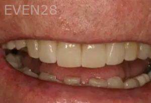 Michael-Hyeonju-Choi-Full-Mouth-Reconstruction-After-9