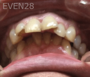 Michael-Sedigh-Dental-Crown-Before-2