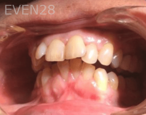 Michael-Sedigh-Dental-Crown-Before-2b