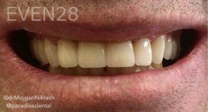 Mojgan-Niktash-Dental-Crowns-after-2