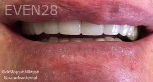 Mojgan-Niktash-Dental-Crowns-after-3