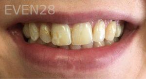 Mojgan-Niktash-Dental-Crowns-before-1