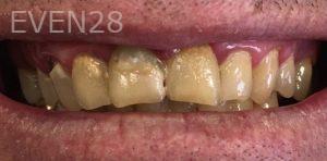 Mojgan-Niktash-Dental-Crowns-before-2