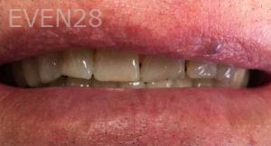 Mojgan-Niktash-Dental-Crowns-before-3
