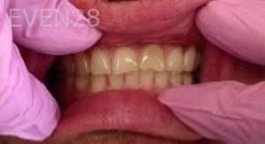 Mojgan-Niktash-Dental-Crowns-before-4