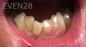 Mojgan-Niktash-Dental-Crowns-before-6