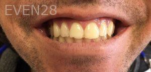 Mojgan-Niktash-Dental-Crowns-before-8