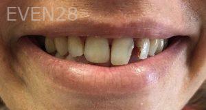 Mojgan-Niktash-Dental-Crowns-before-9